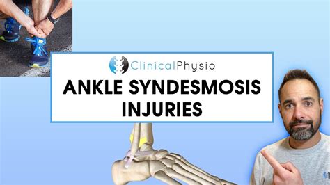 syndesmosis tear test|syndesmosis ankle surgery recovery time.